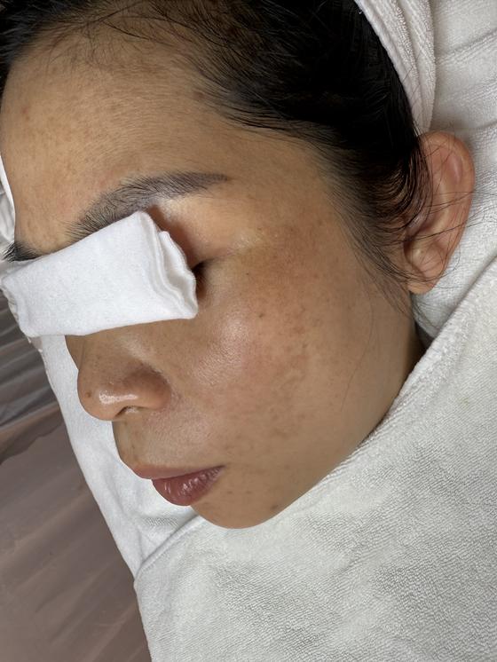 Kết quả khách hàng liệu trình nám