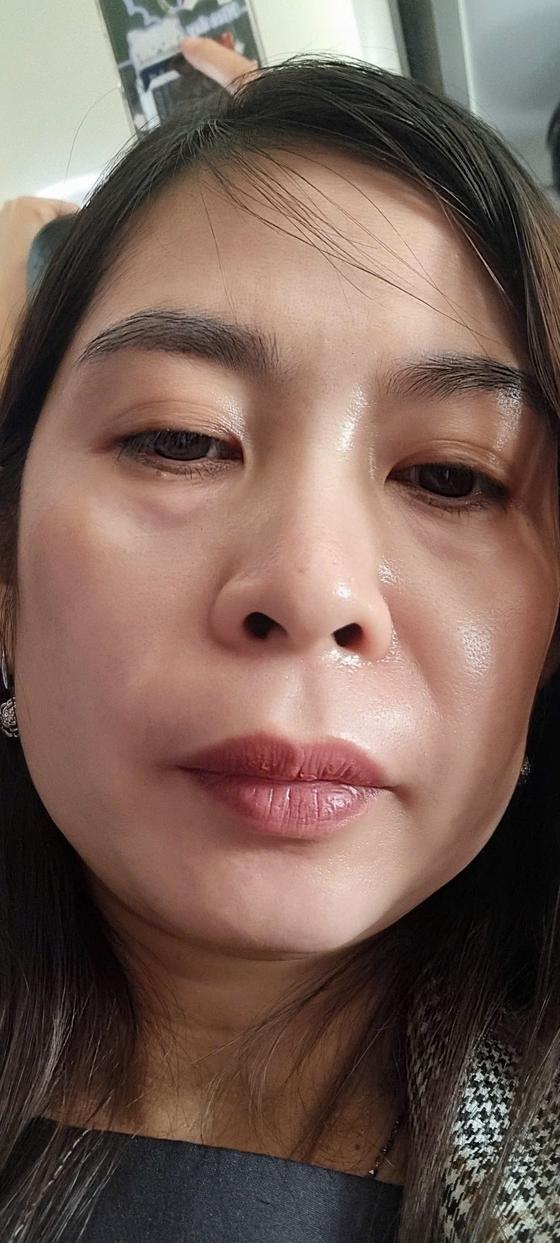Kết quả khách hàng liệu trình nám
